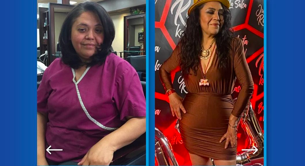 best kept secret in louisiana: gastric sleeve surgery